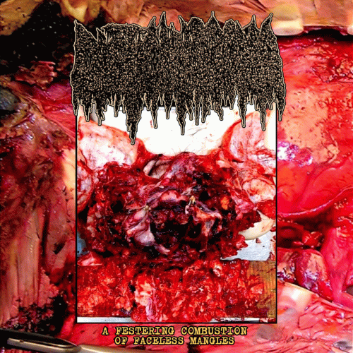 Cystic Hygroma : A Festering Combustion of Faceless Mangles